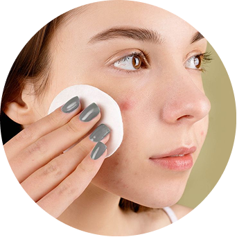Acne-Prone